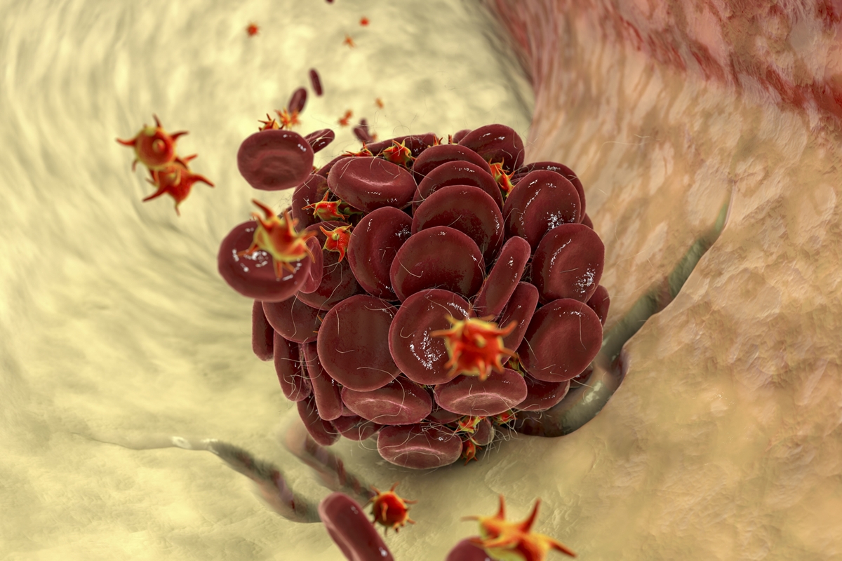 Médico vascular aponta fatores de risco e o que ajuda a prevenir a trombose