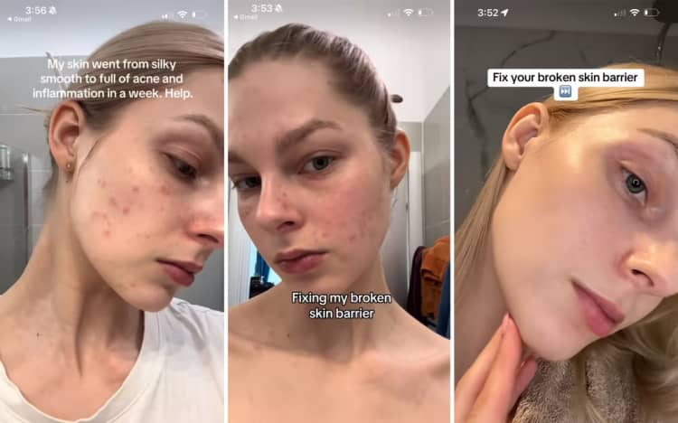 The “glass skin” social media trend promises a dewy glow, but dermatologists warn that complicated routines can irritate skin and damage its protective barrier.